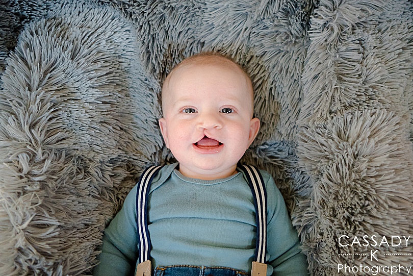 Cleft pallet baby boy after first surgery and after surgery for a 2020 photography review